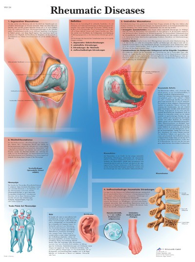 All Products - Rheumatic Diseases